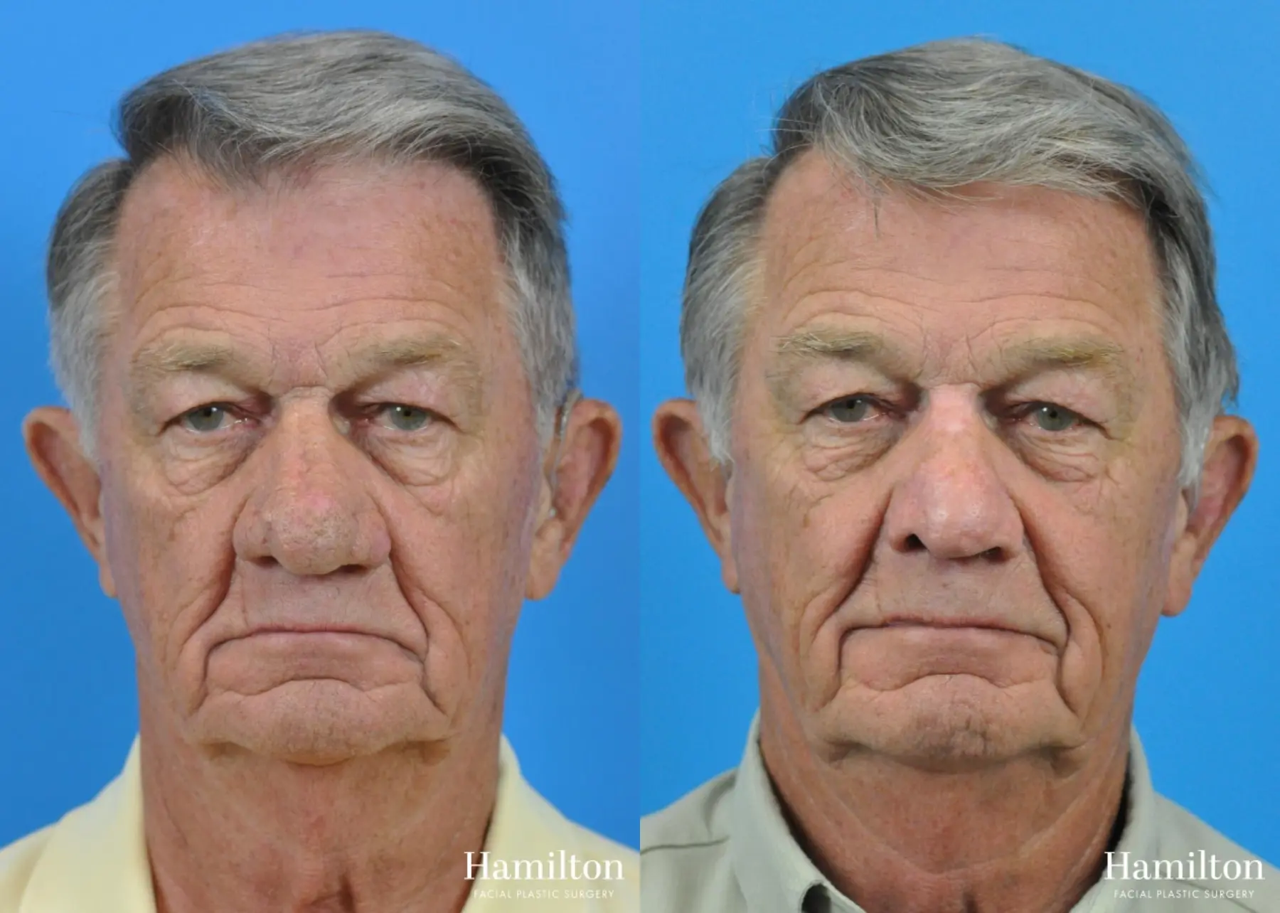 Rhinophyma: Patient 2 - Before and After 3