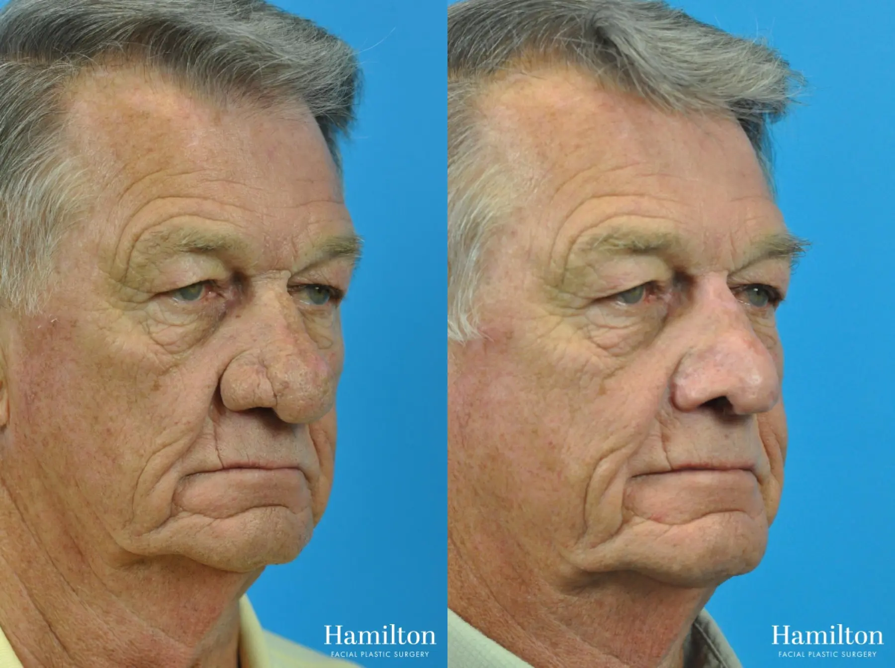 Rhinophyma: Patient 2 - Before and After  