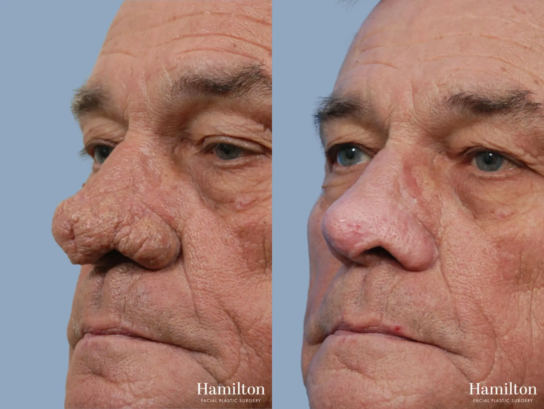 Rhinophyma: Patient 1 - Before and After  