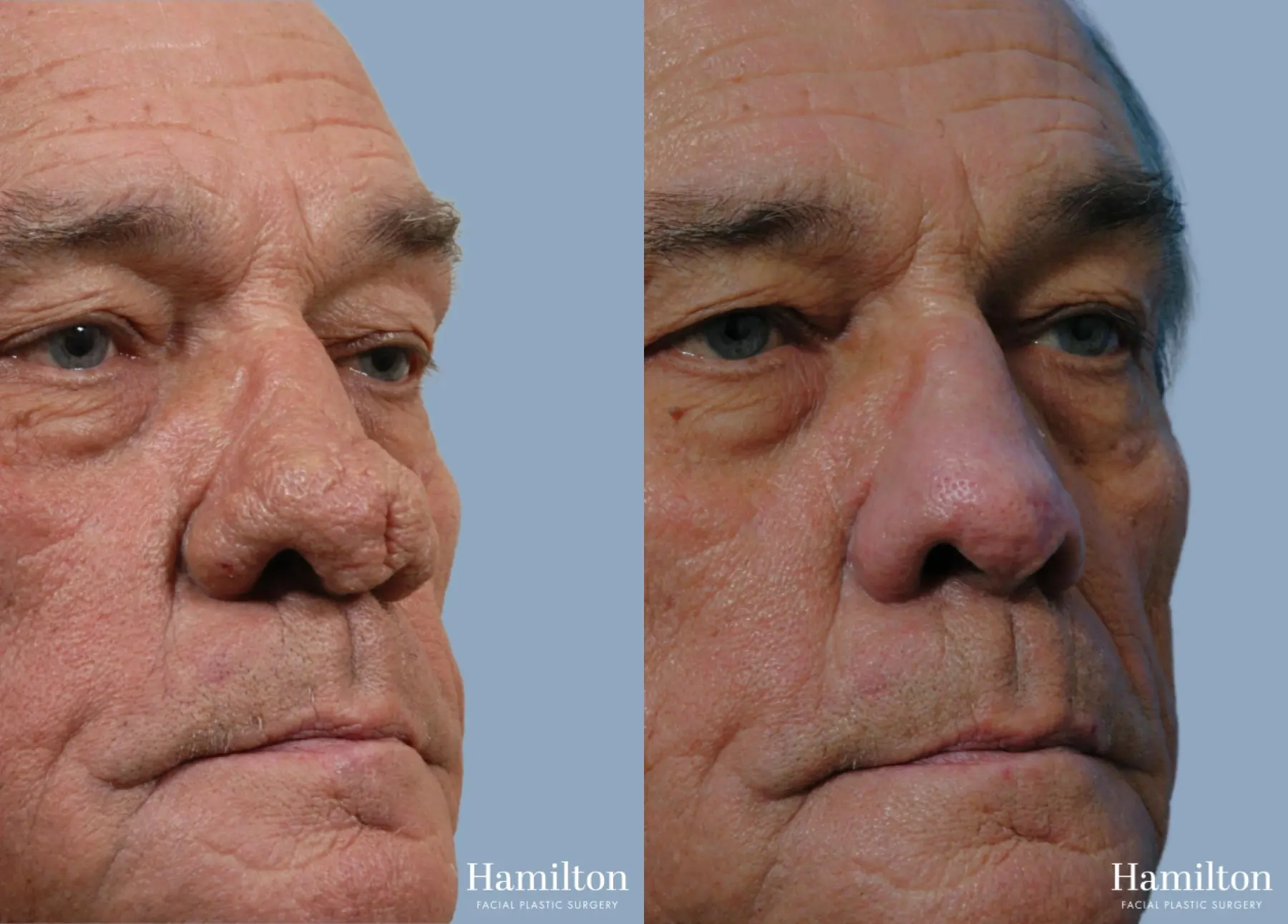 Rhinophyma: Patient 1 - Before and After 2