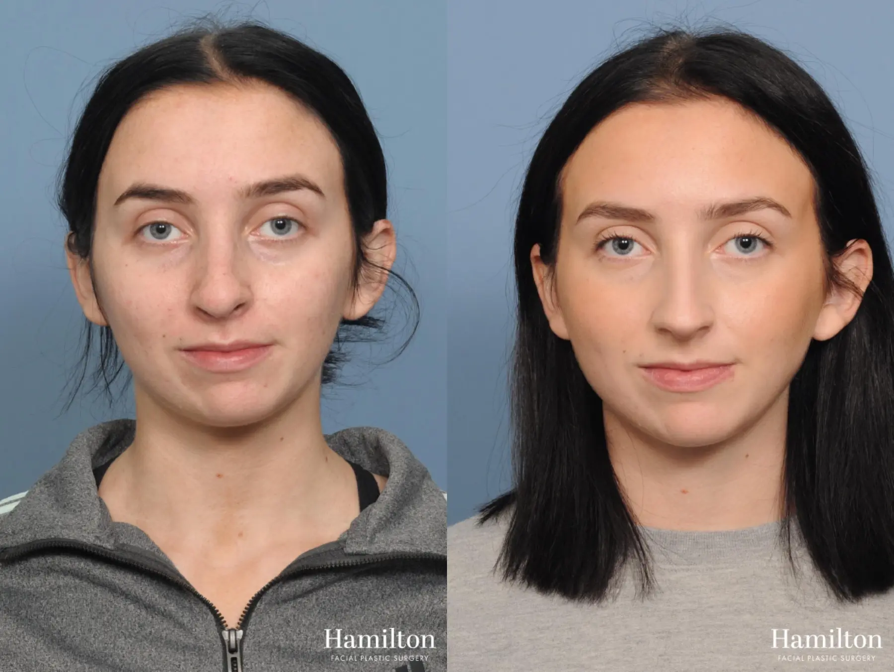 Rhinoplasty: Patient 2 - Before and After 4