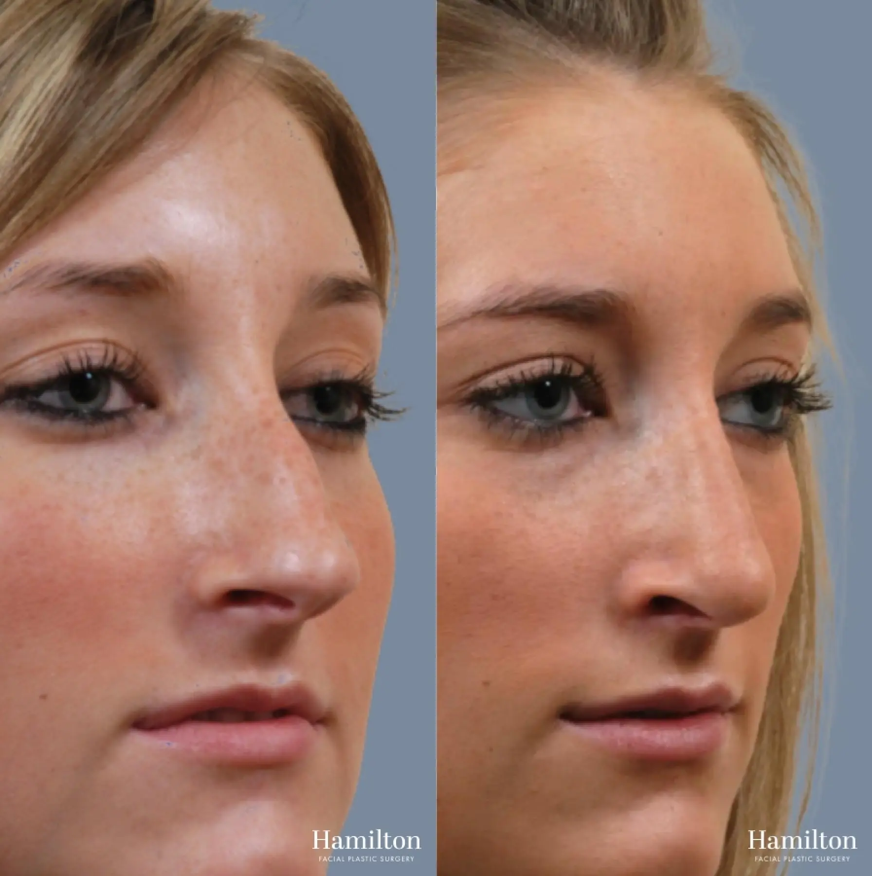 Rhinoplasty: Patient 7 - Before and After 3