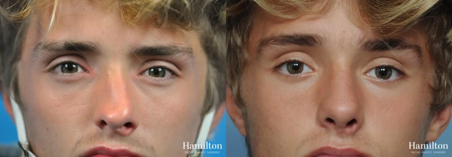 Rhinoplasty: Patient 11 - Before and After 1