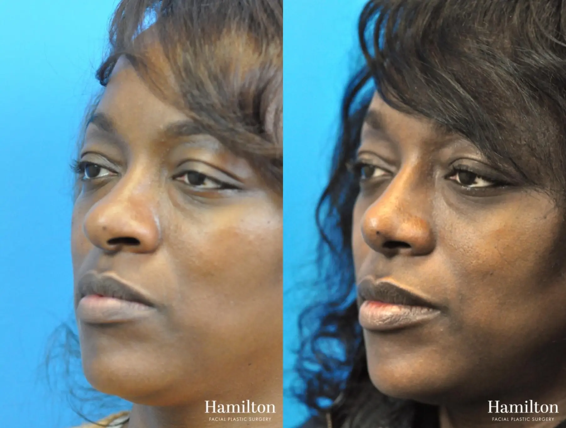 Rhinoplasty: Patient 25 - Before and After 5