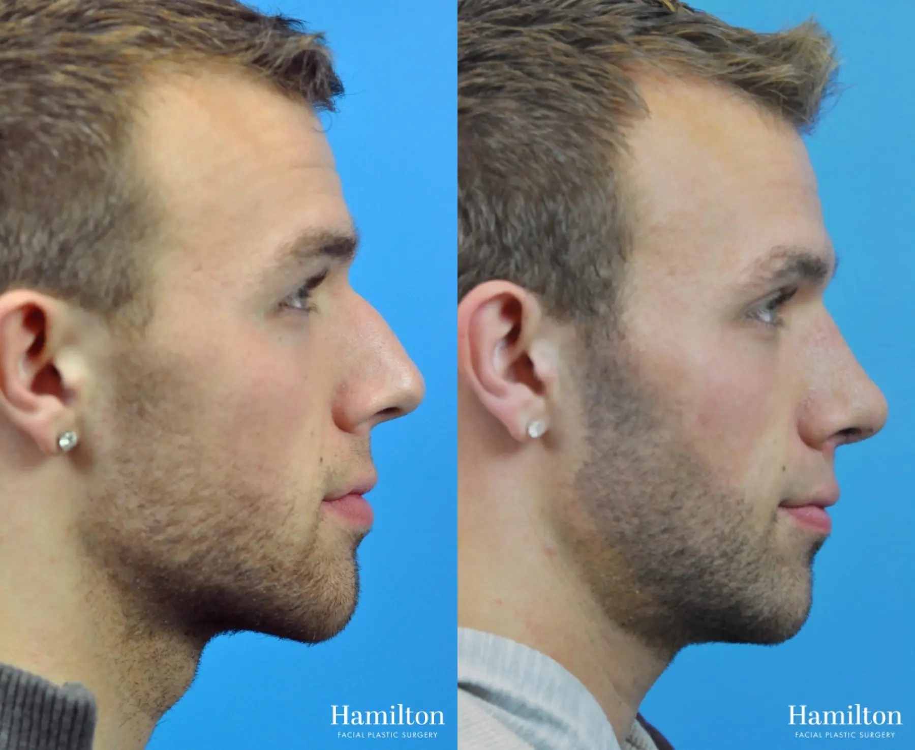 Rhinoplasty: Patient 10 - Before and After 2