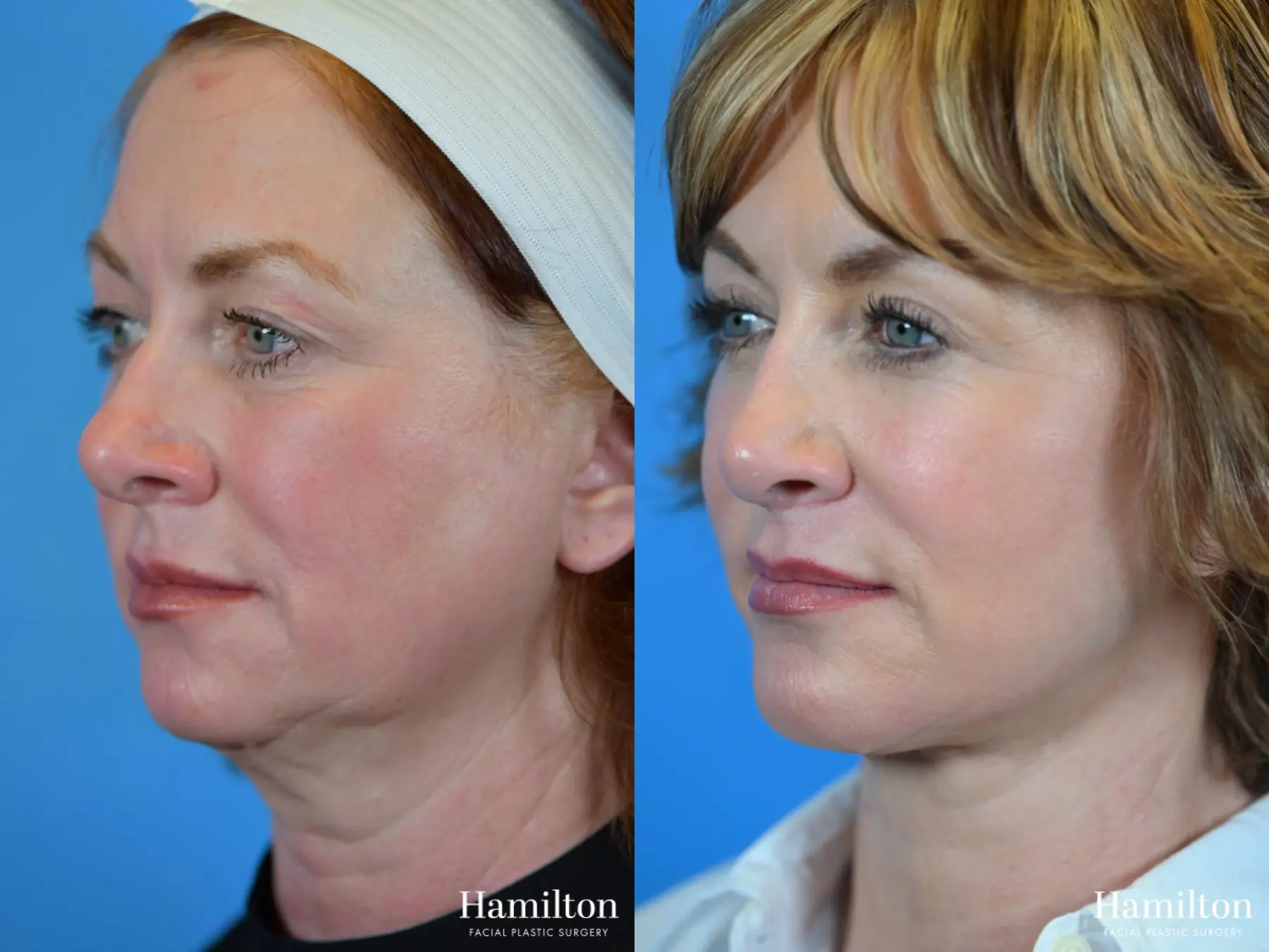 Rhinoplasty: Patient 26 - Before and After 1