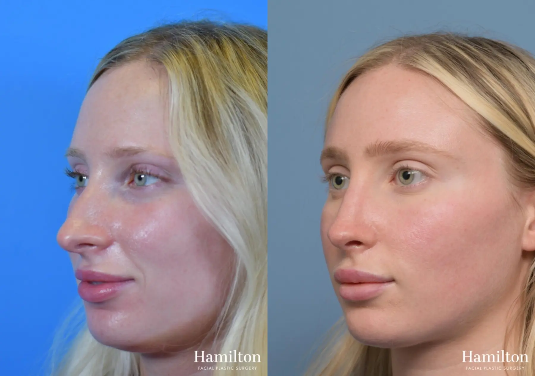 Rhinoplasty: Patient 3 - Before and After 4