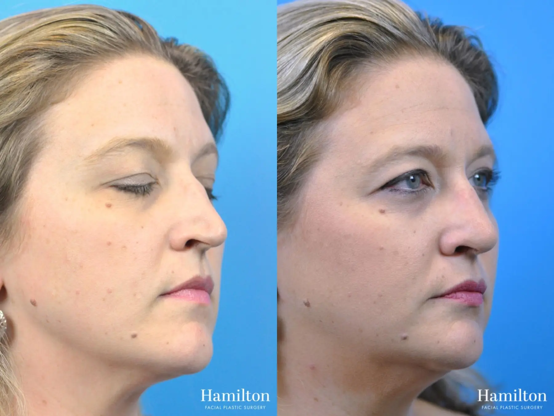 Rhinoplasty: Patient 34 - Before and After 3