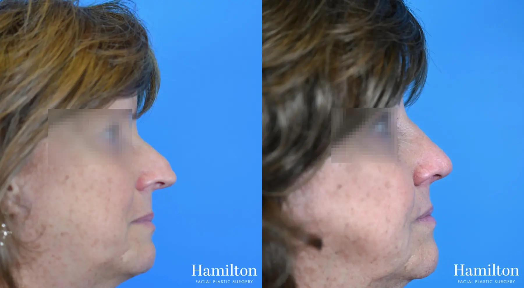 Rhinoplasty: Patient 40 - Before and After 2