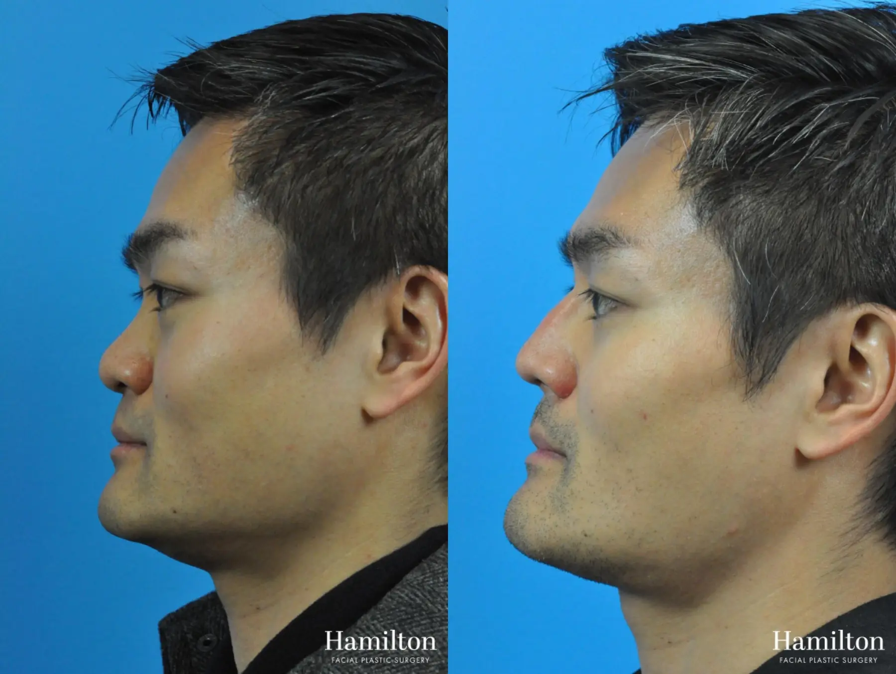 Rhinoplasty: Patient 23 - Before and After 4