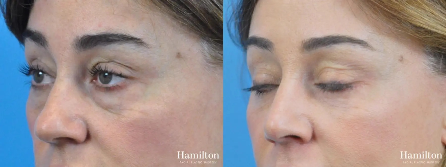 Rhinoplasty: Patient 33 - Before and After 3