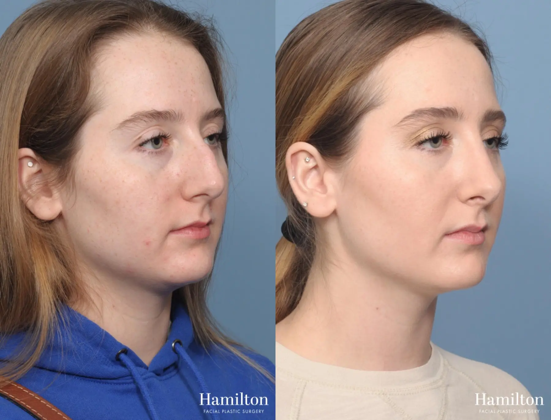 Rhinoplasty: Patient 1 - Before and After 3