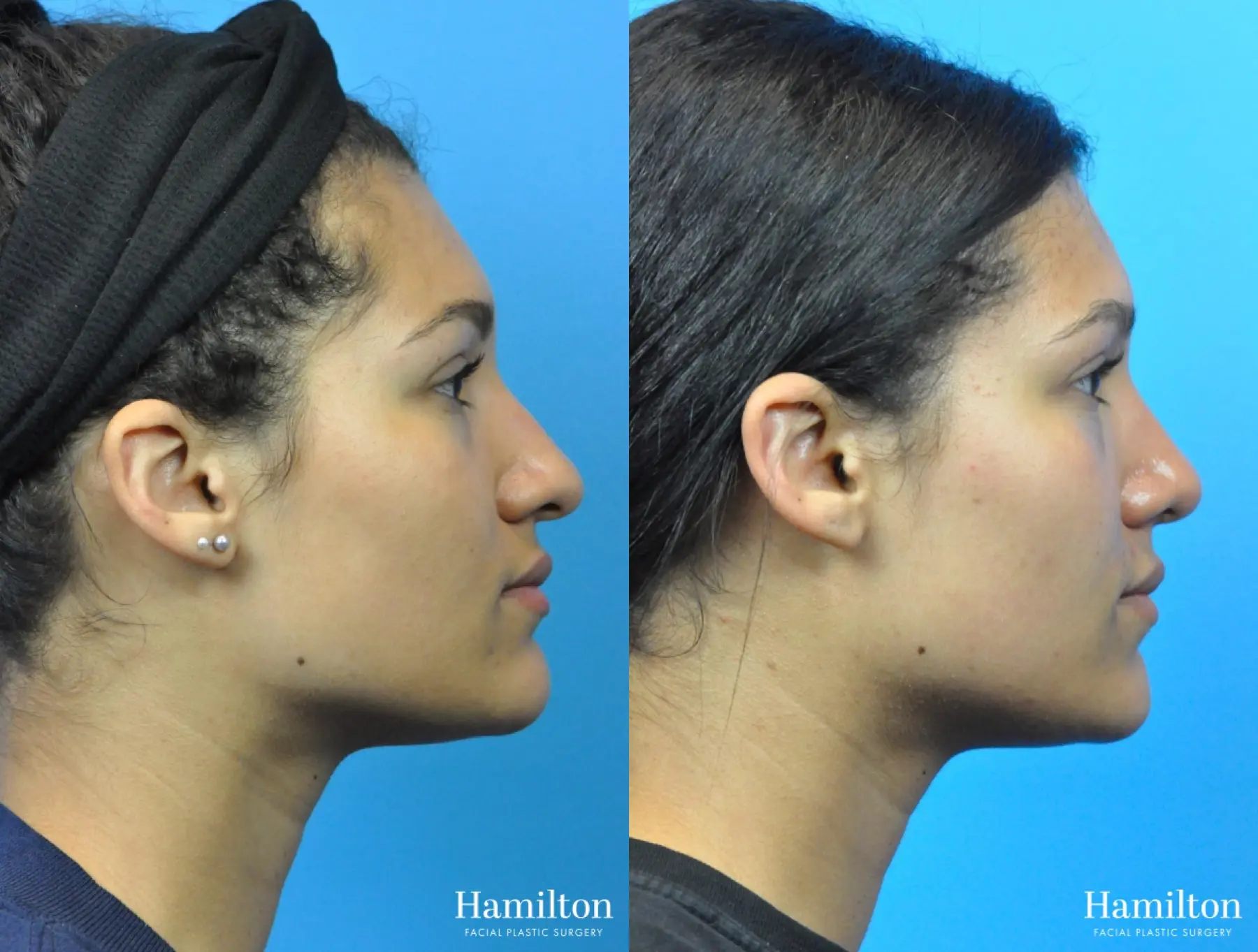 Rhinoplasty: Patient 43 - Before and After 3