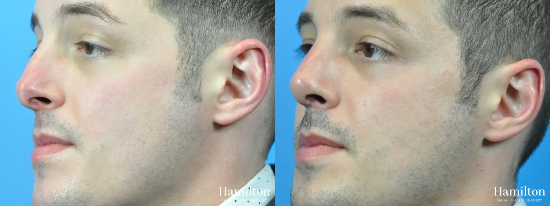 Rhinoplasty: Patient 35 - Before and After 3