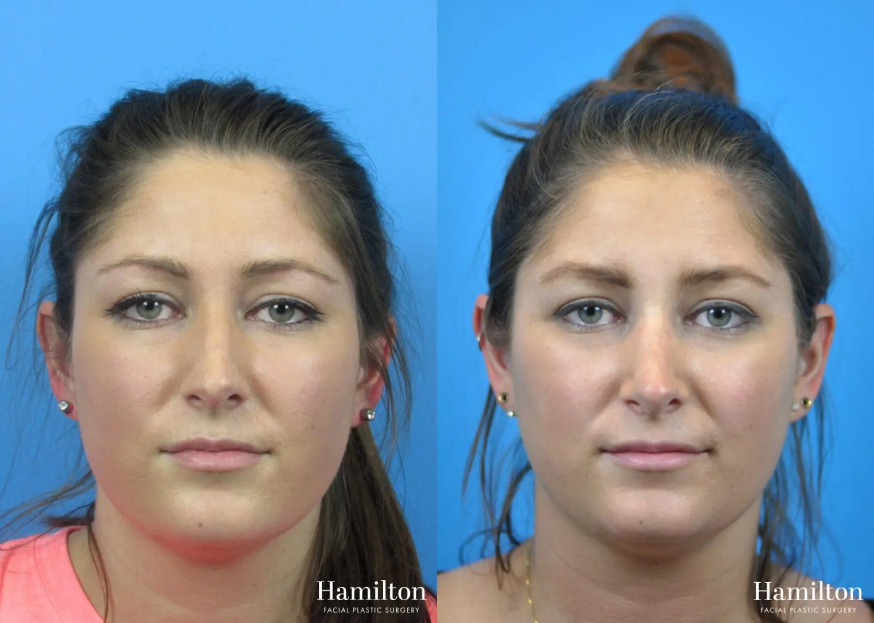 Rhinoplasty: Patient 32 - Before and After 5