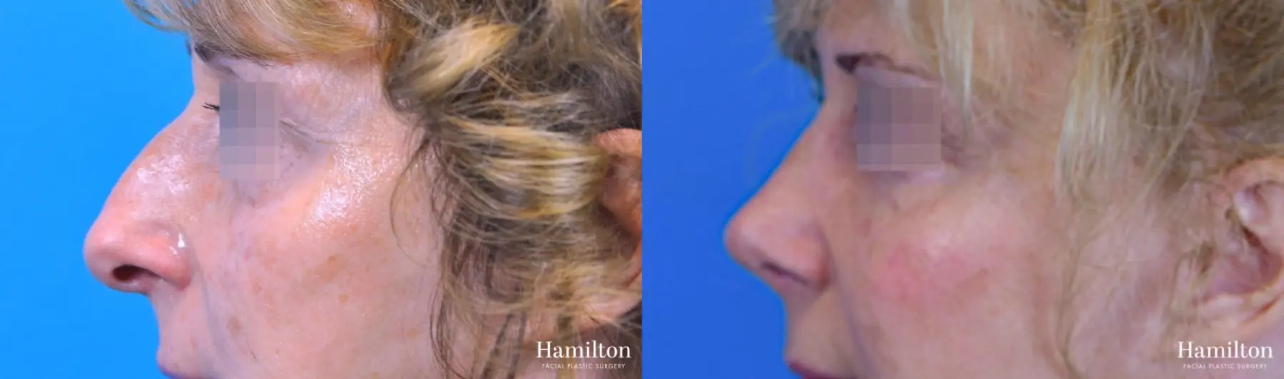 Rhinoplasty: Patient 45 - Before and After 3