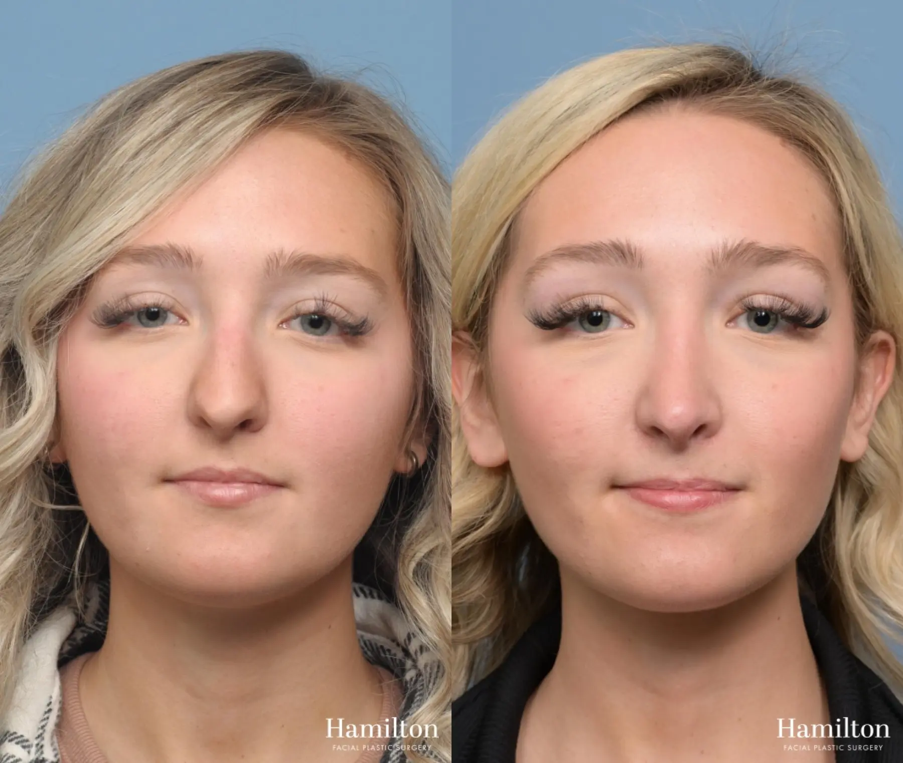 Rhinoplasty: Patient 6 - Before and After  