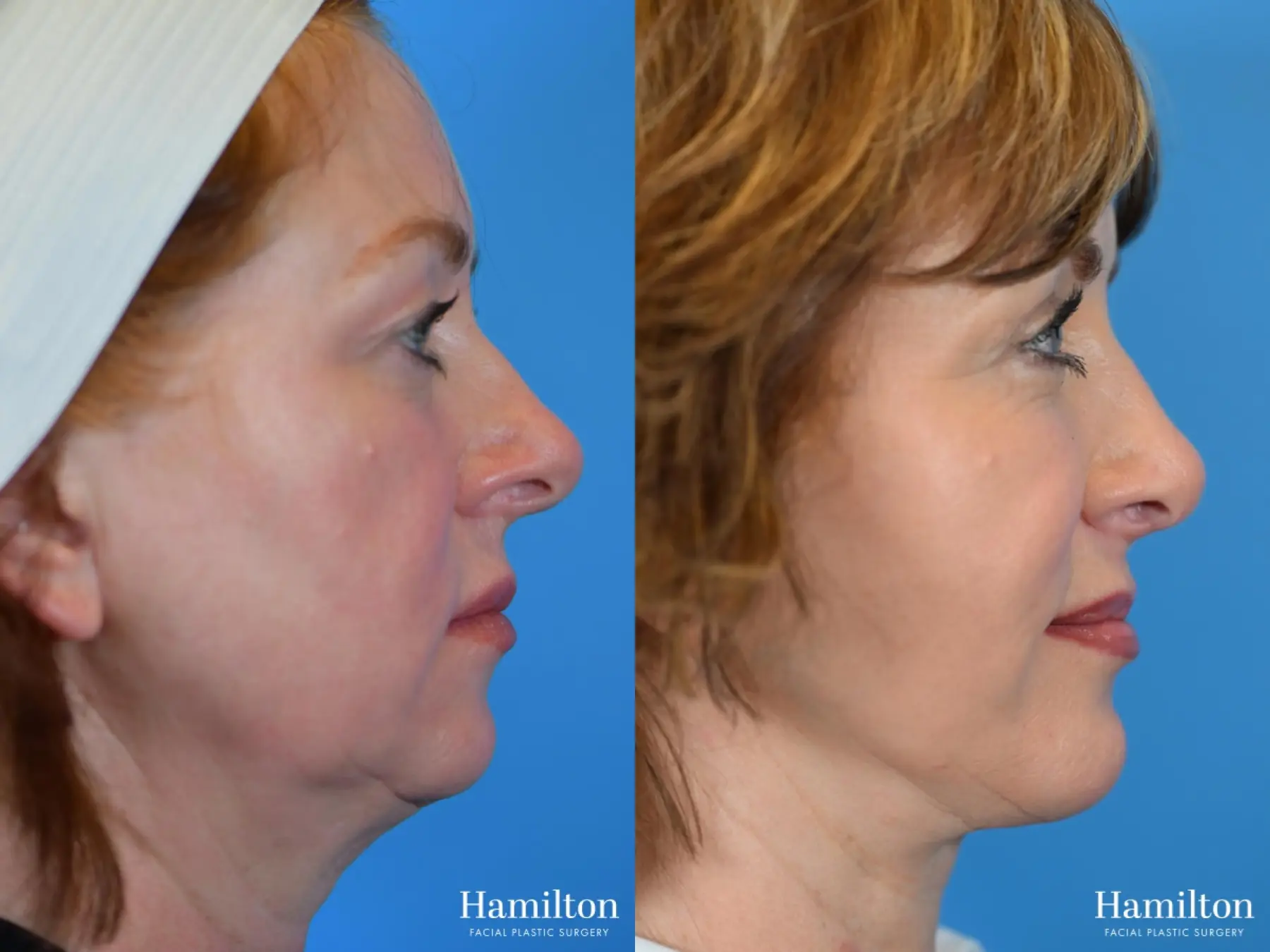 Rhinoplasty: Patient 26 - Before and After 4