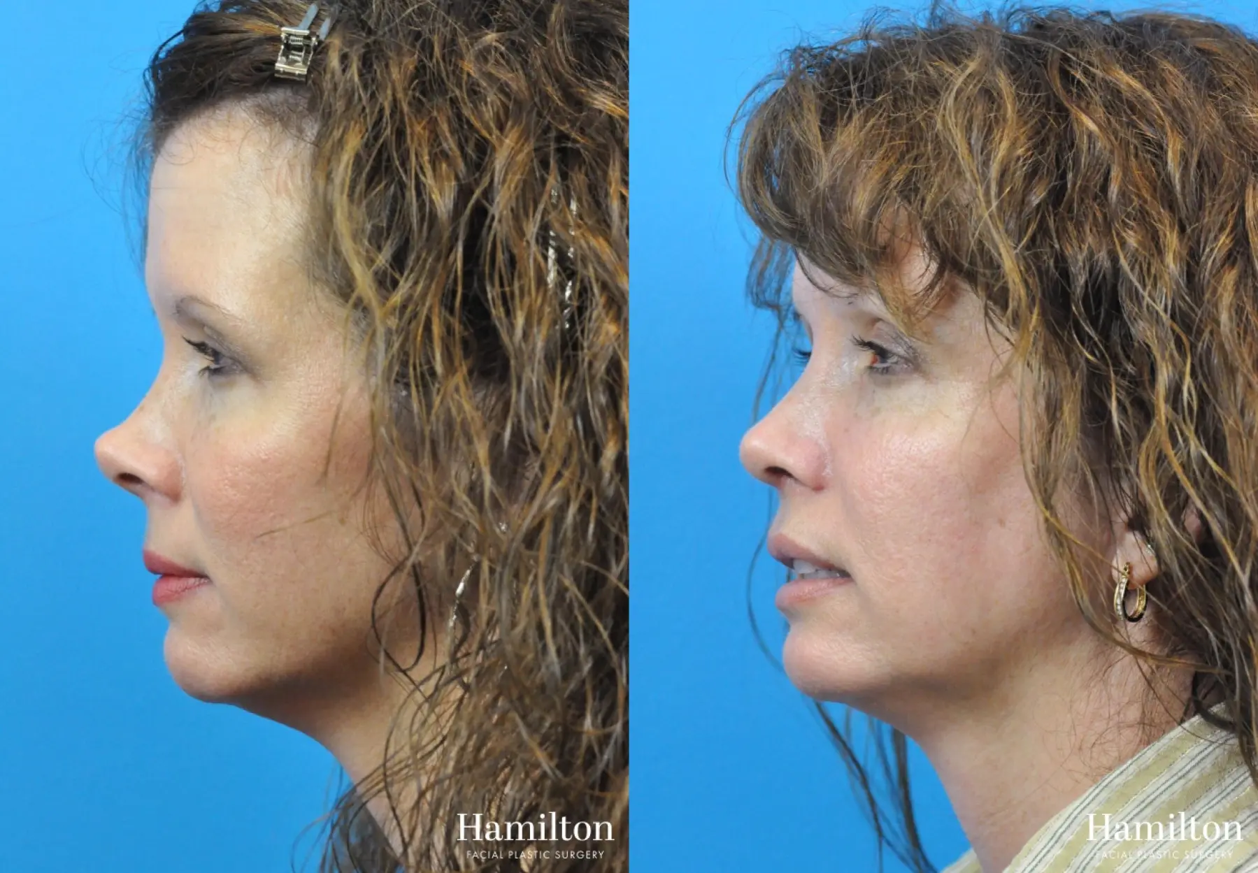 Rhinoplasty: Patient 24 - Before and After 1