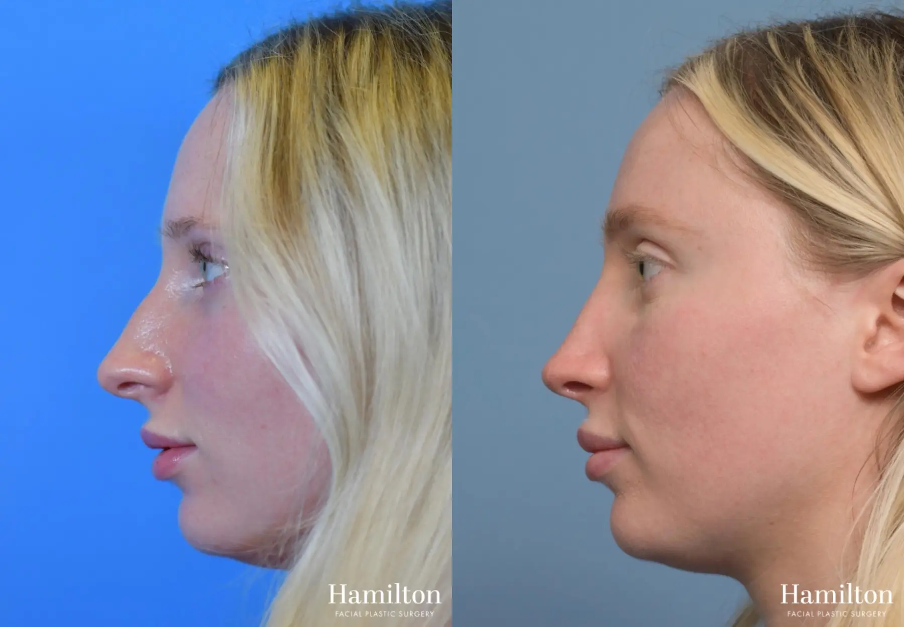 Rhinoplasty: Patient 3 - Before and After 3