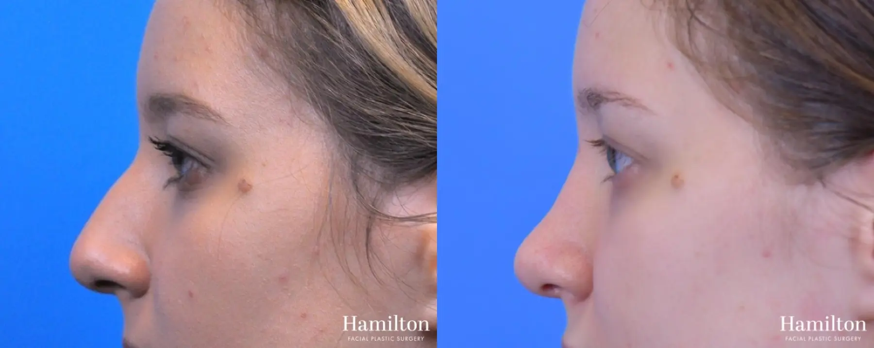 Rhinoplasty: Patient 18 - Before and After 2