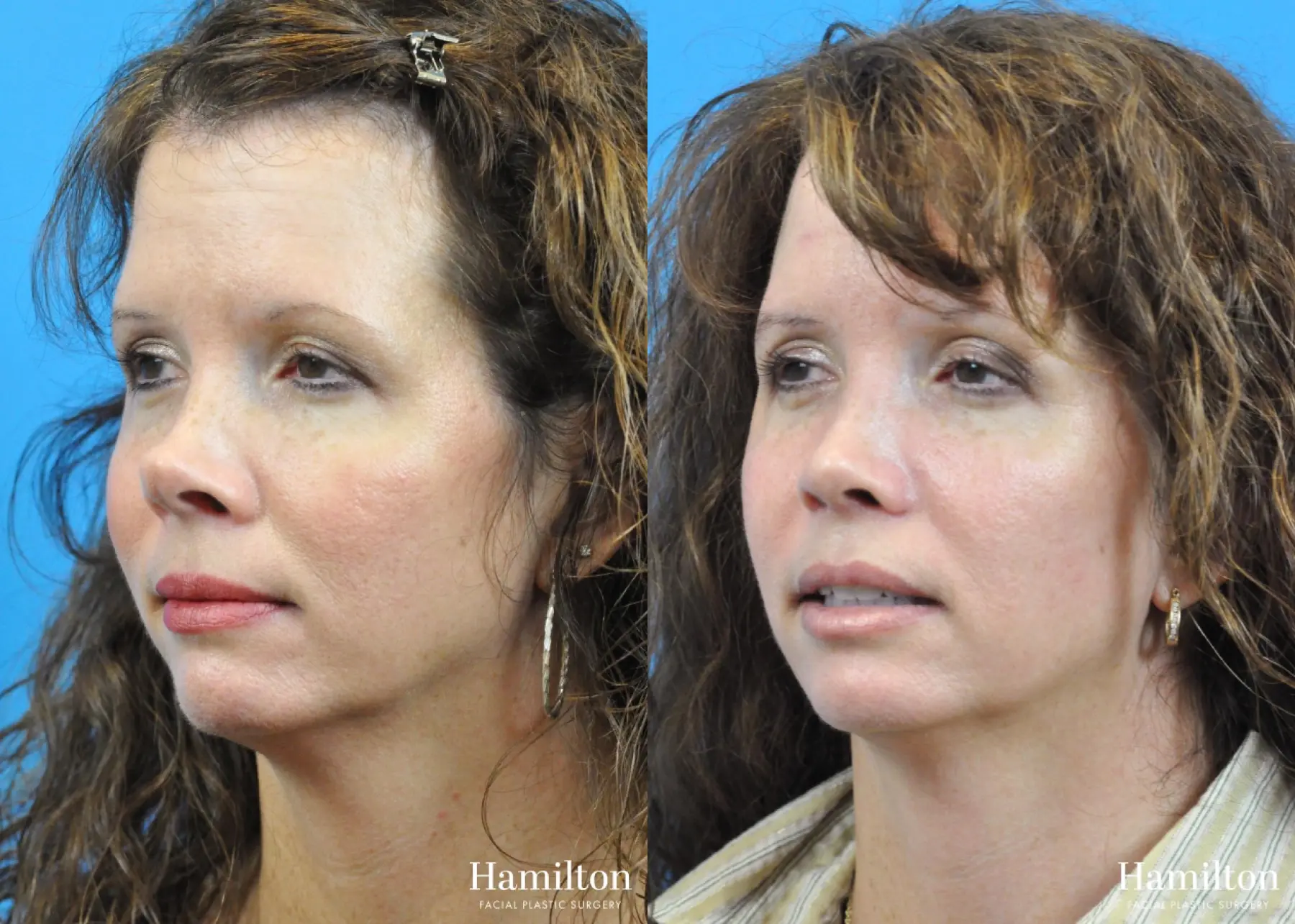 Rhinoplasty: Patient 24 - Before and After 3