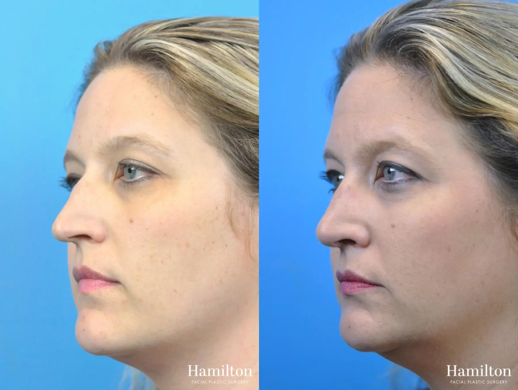 Rhinoplasty: Patient 34 - Before and After 4