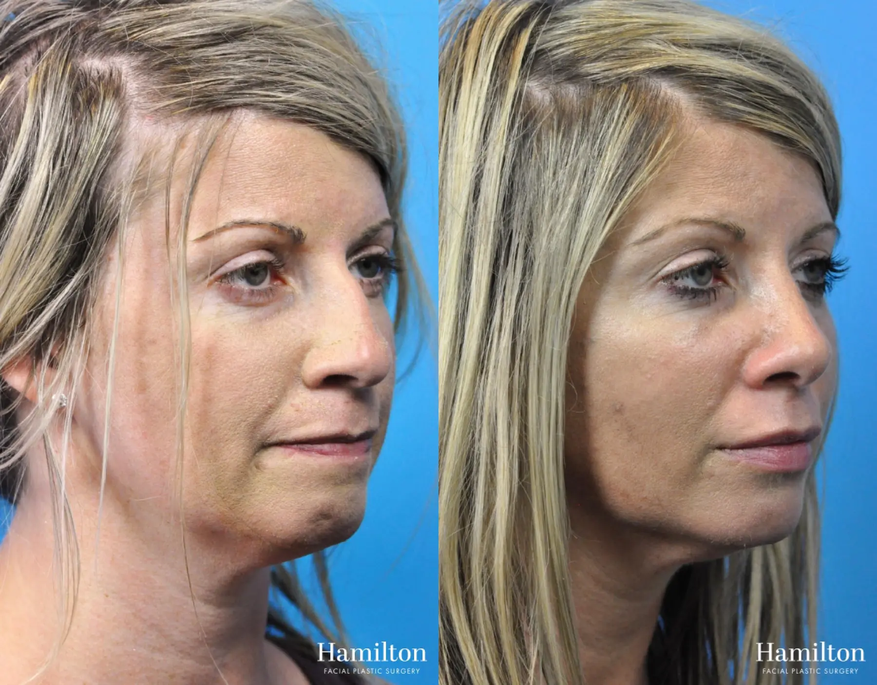 Rhinoplasty: Patient 32 - Before and After 4