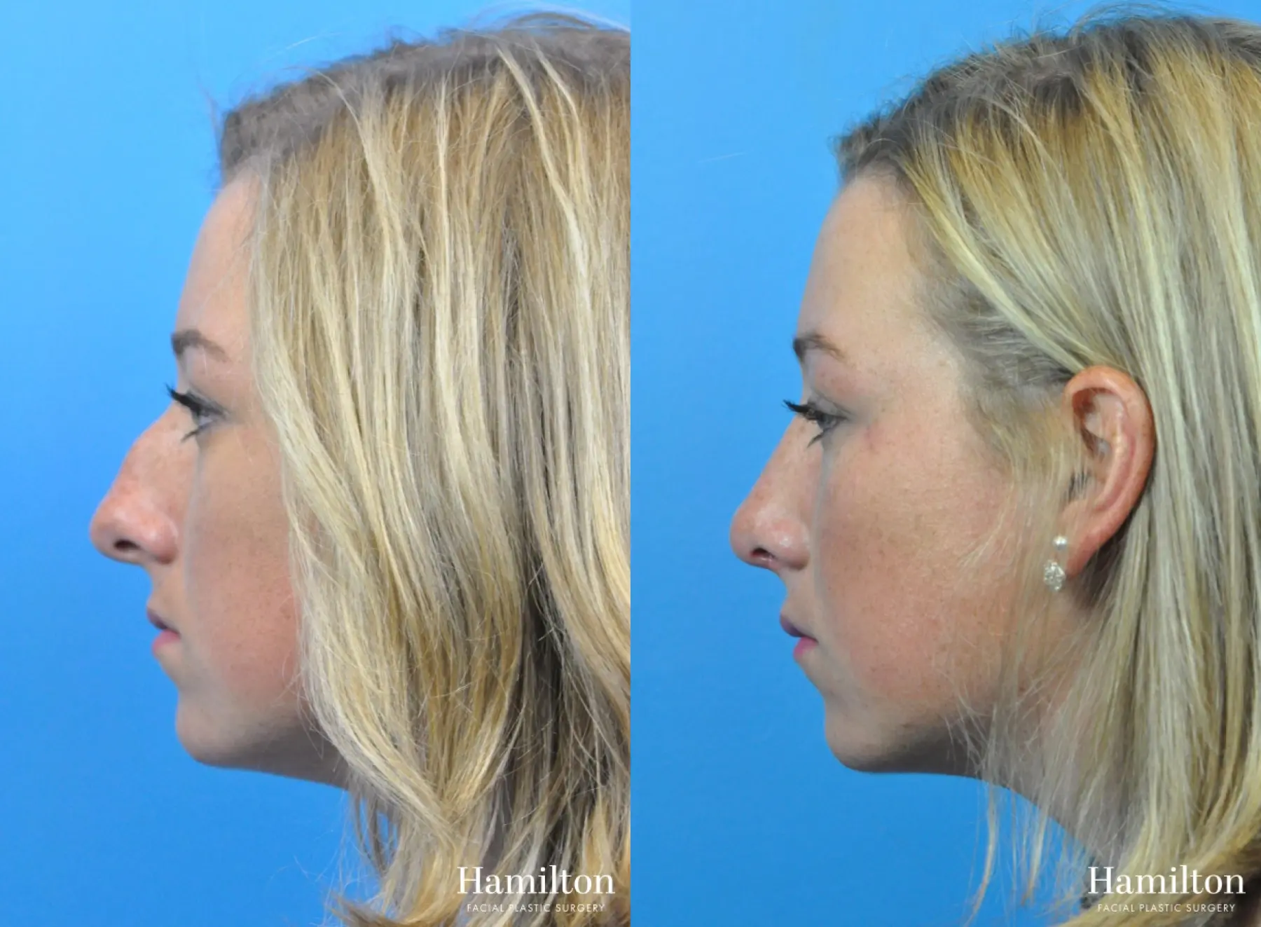 Rhinoplasty: Patient 31 - Before and After 1