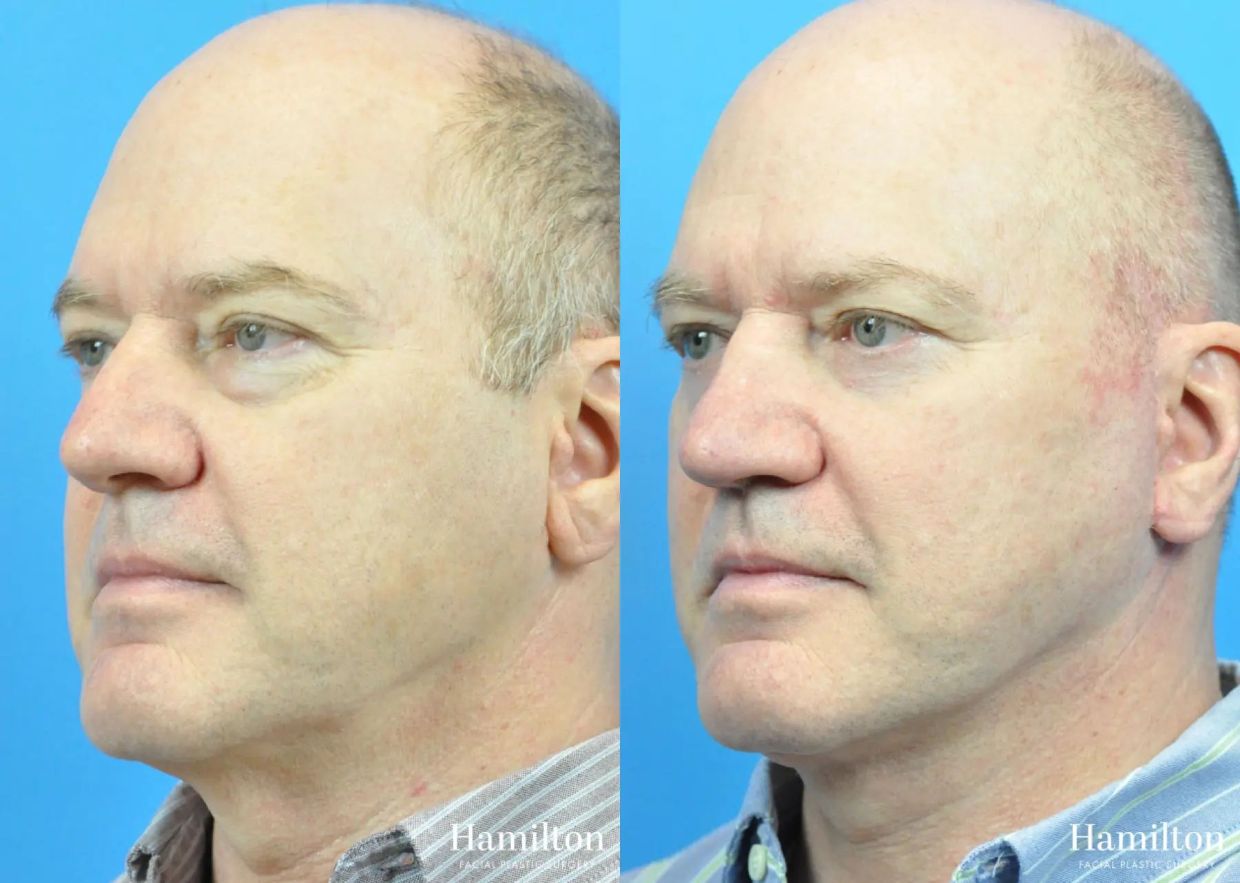 Rhinoplasty: Patient 19 - Before and After 4