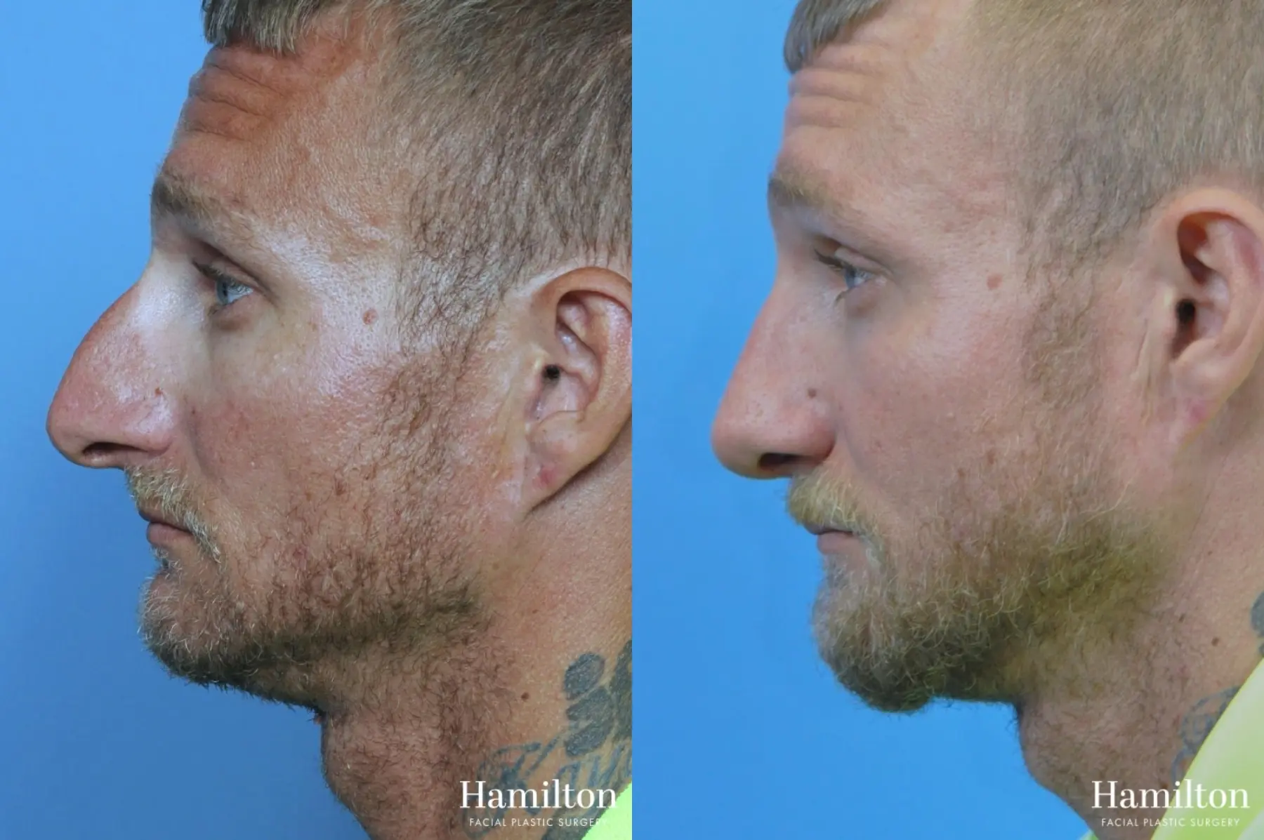 Rhinoplasty: Patient 31 - Before and After 1