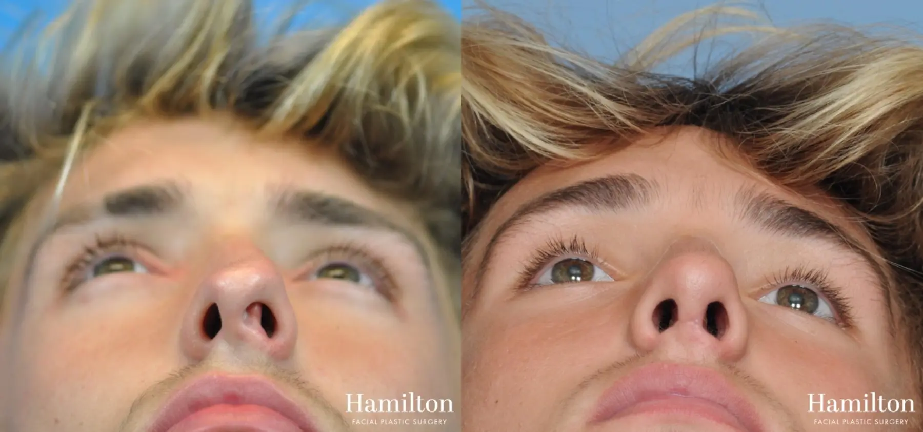 Rhinoplasty: Patient 11 - Before and After 2