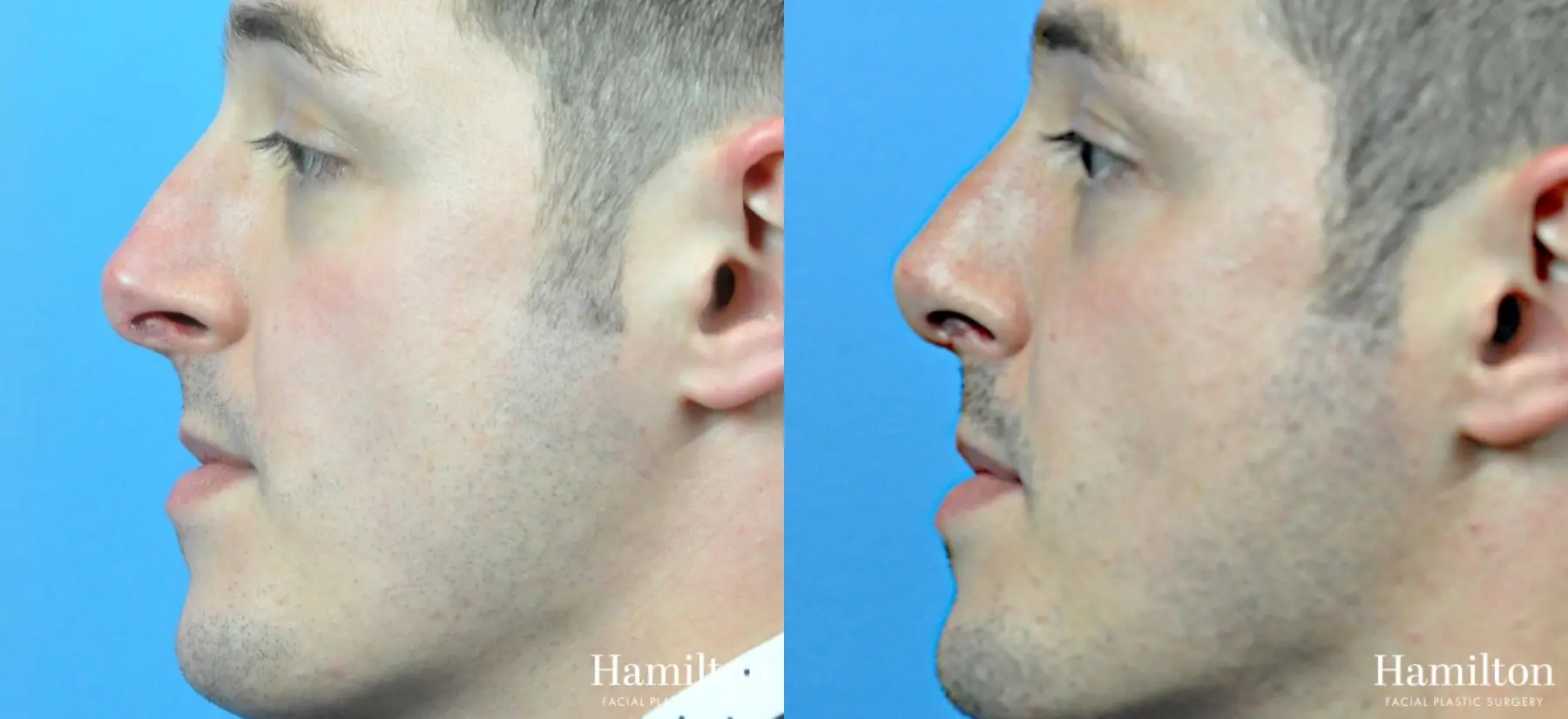 Rhinoplasty: Patient 35 - Before and After 6