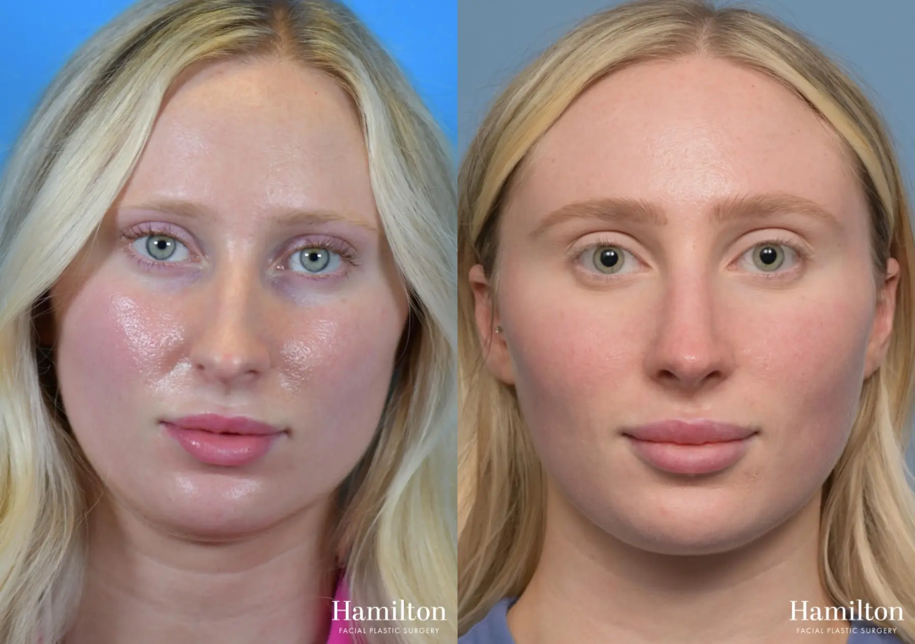 Rhinoplasty: Patient 3 - Before and After 5