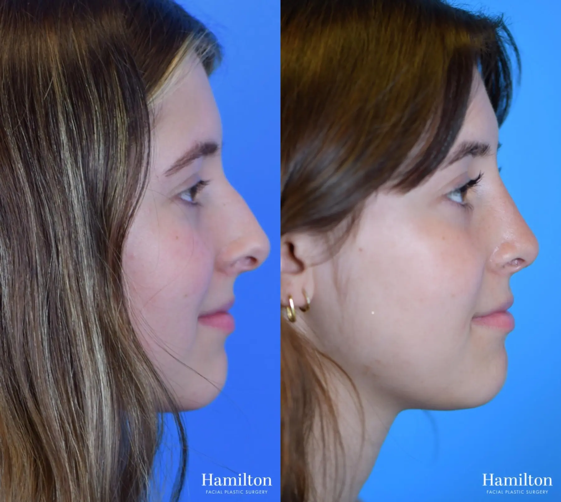 Rhinoplasty: Patient 41 - Before and After 3