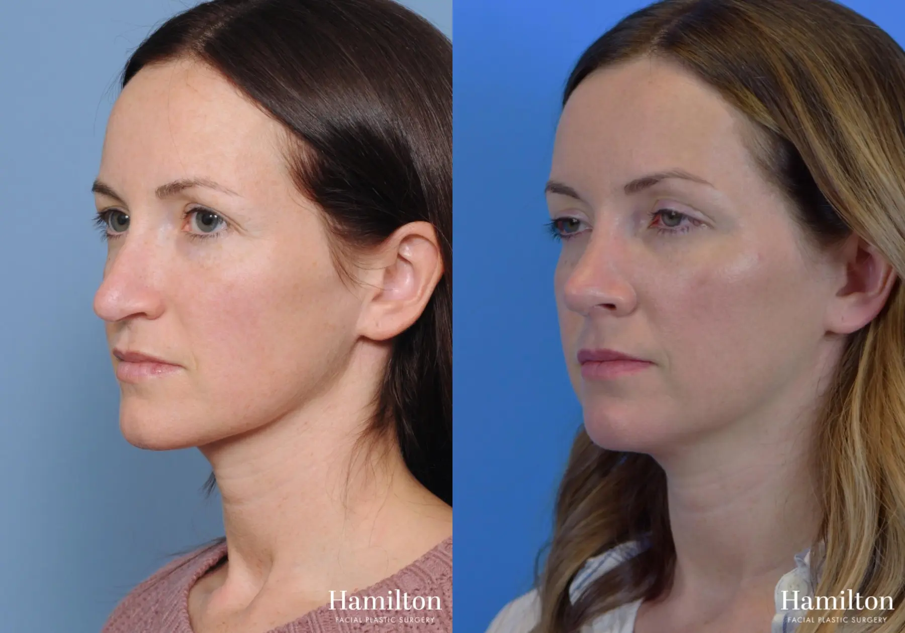 Rhinoplasty: Patient 7 - Before and After 6