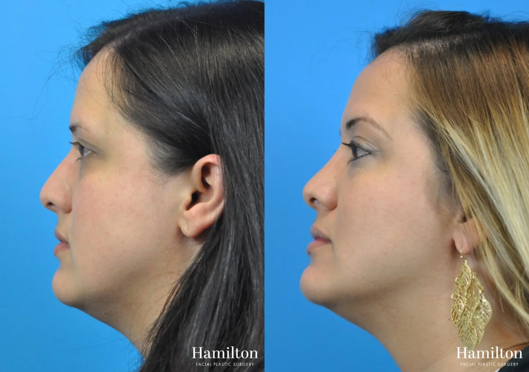 Rhinoplasty: Patient 36 - Before and After 3