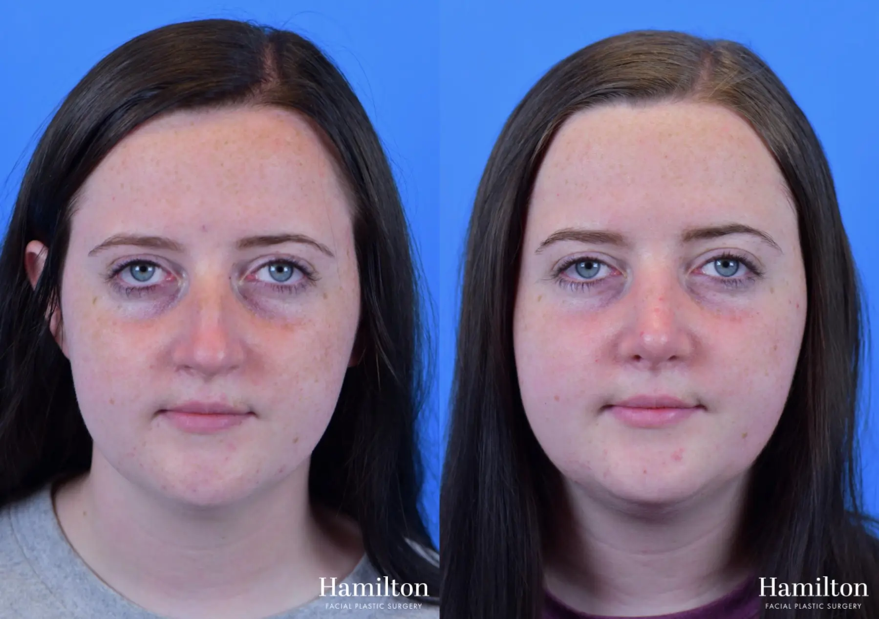 Rhinoplasty: Patient 42 - Before and After 5