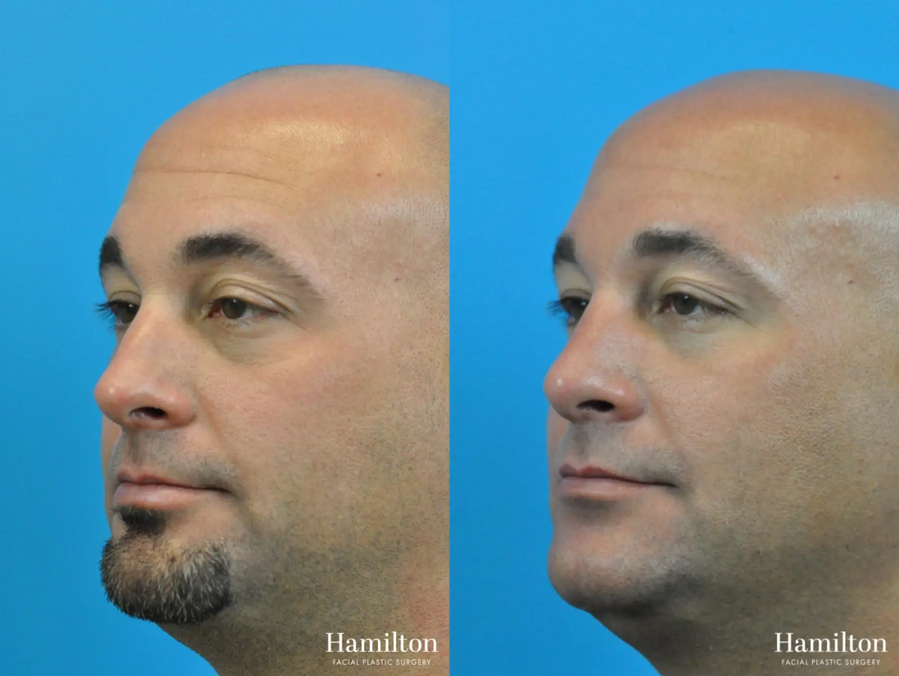 Rhinoplasty: Patient 12 - Before and After 4