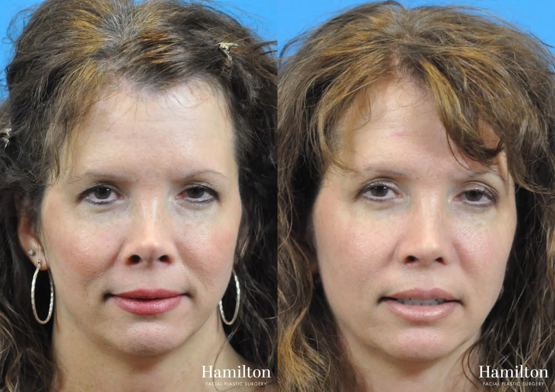 Rhinoplasty: Patient 24 - Before and After 4