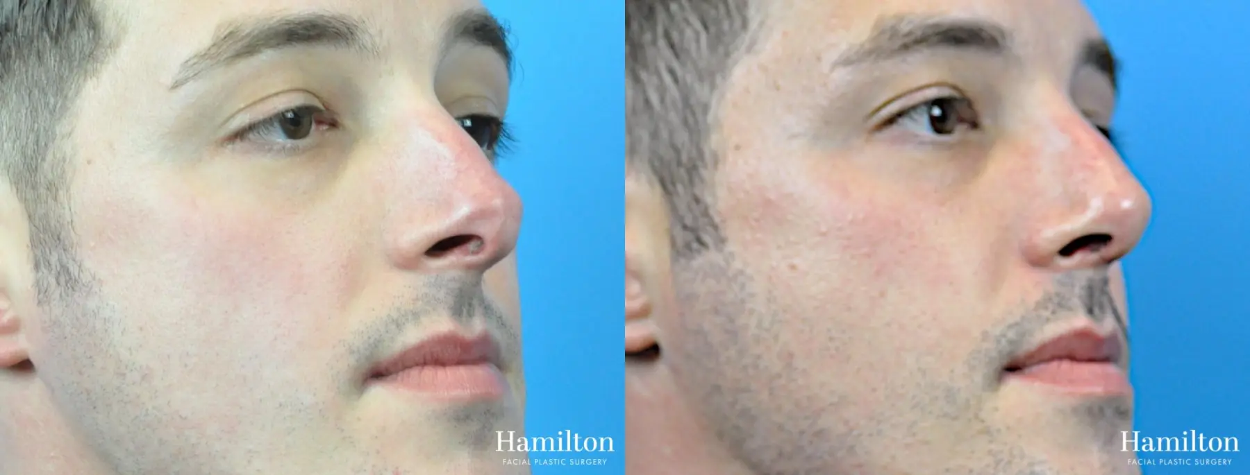 Rhinoplasty: Patient 35 - Before and After 4