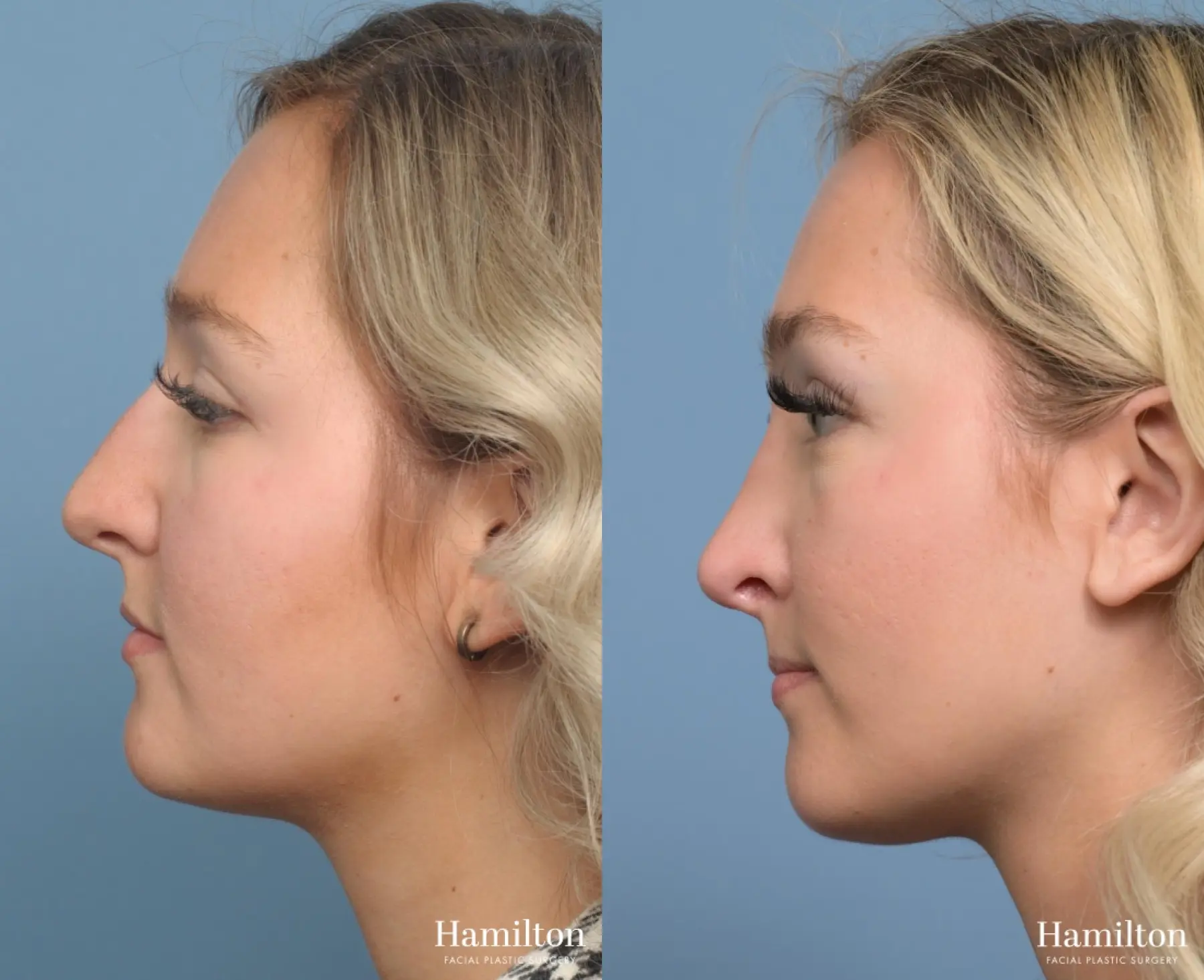 Rhinoplasty: Patient 6 - Before and After 4