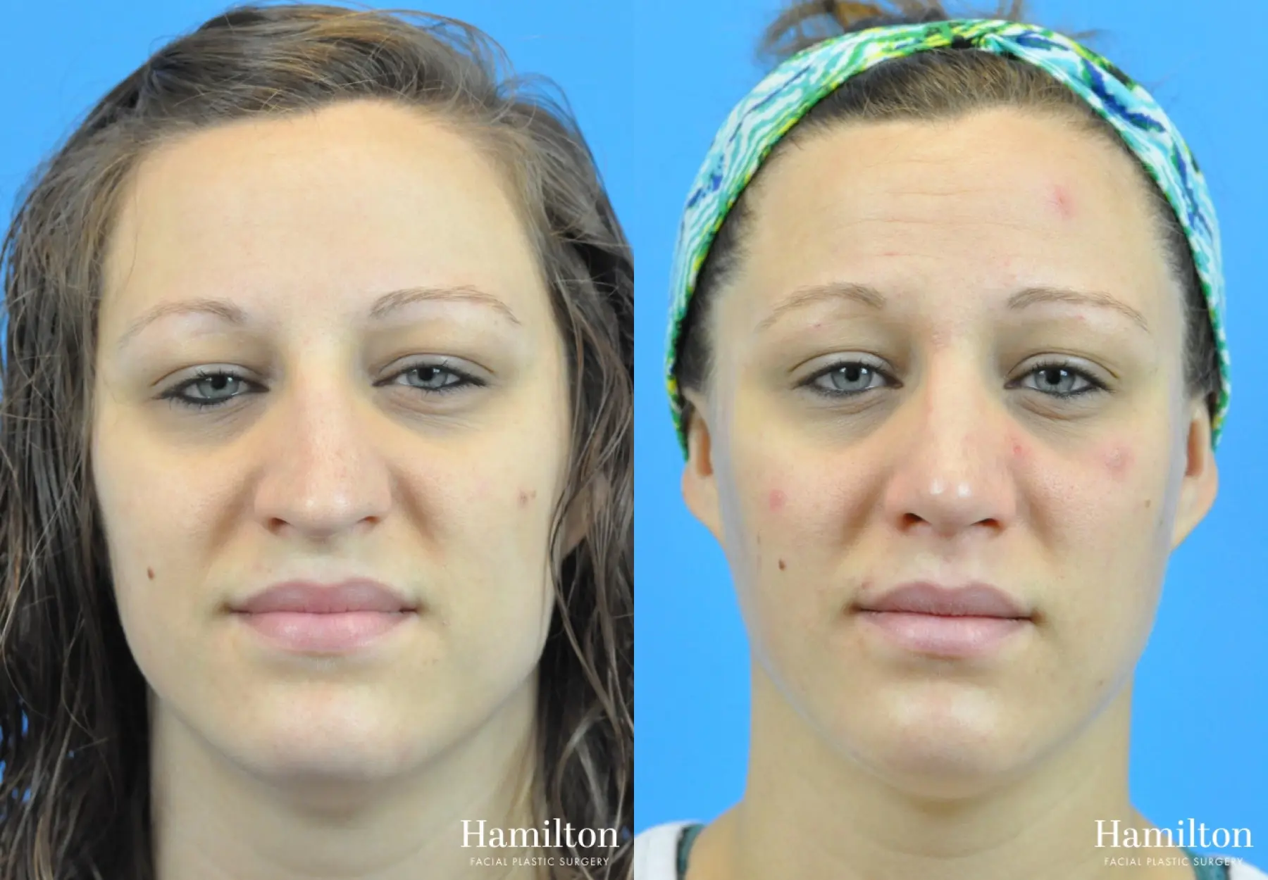 Rhinoplasty: Patient 49 - Before and After 5