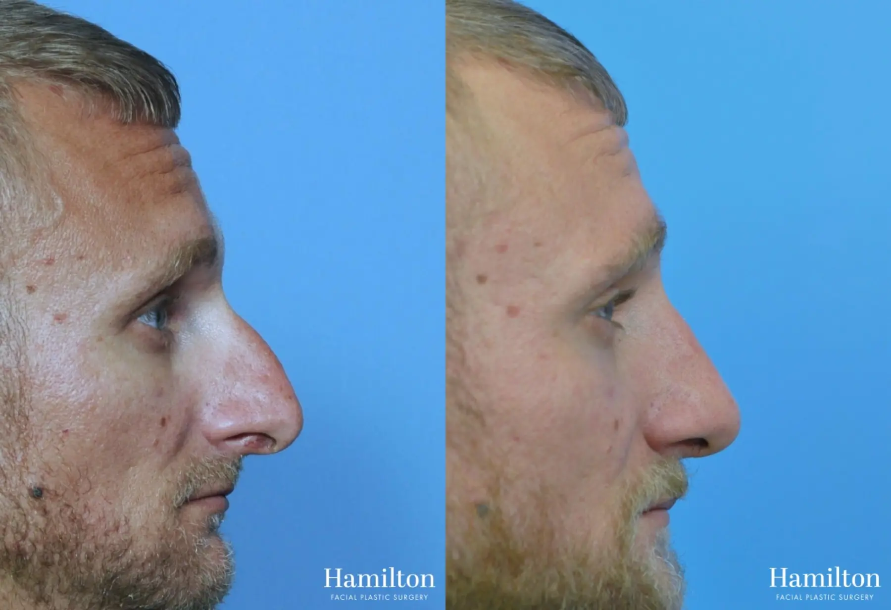 Rhinoplasty: Patient 31 - Before and After 3