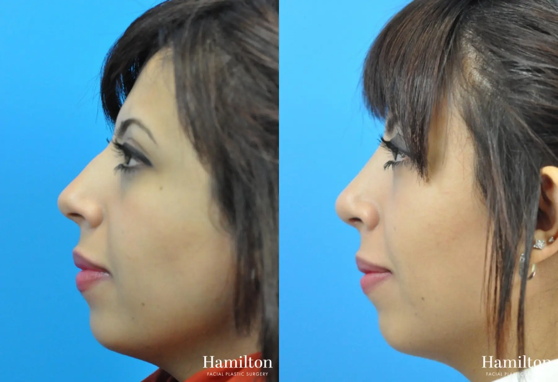 Rhinoplasty: Patient 16 - Before and After 2