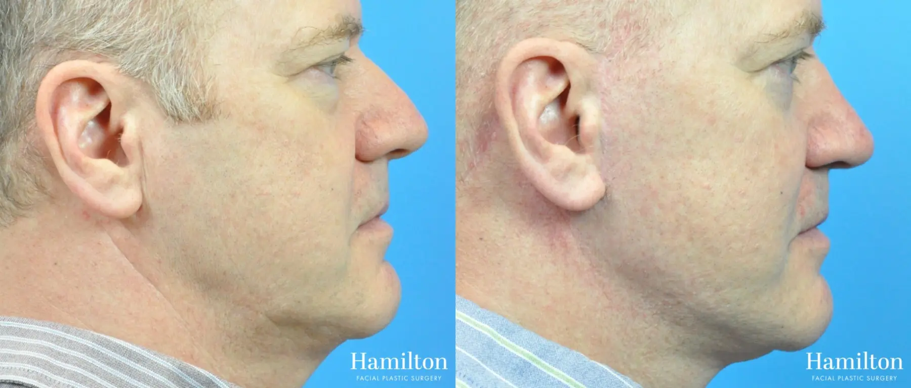 Rhinoplasty: Patient 19 - Before and After 1