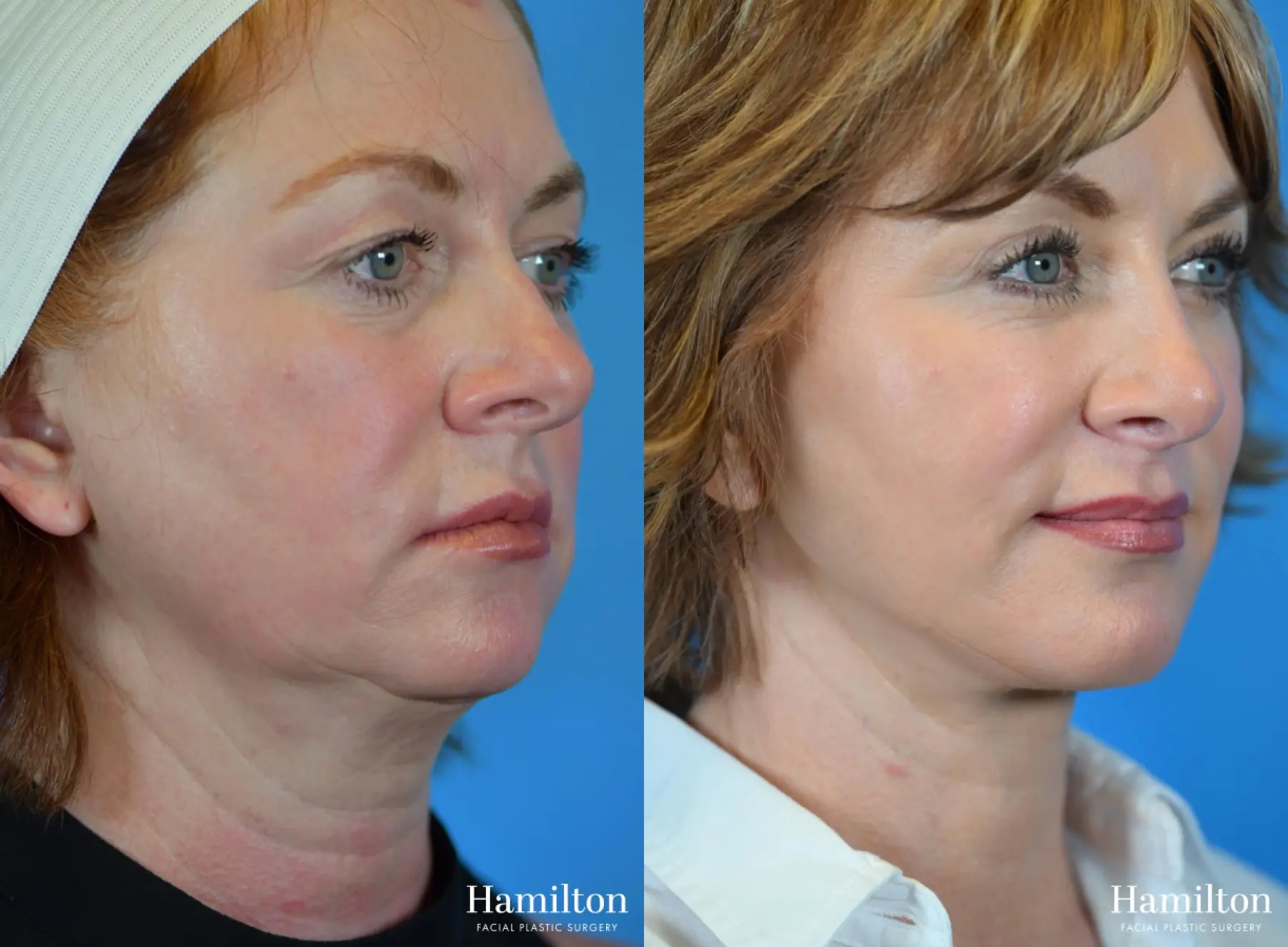 Rhinoplasty: Patient 26 - Before and After 2