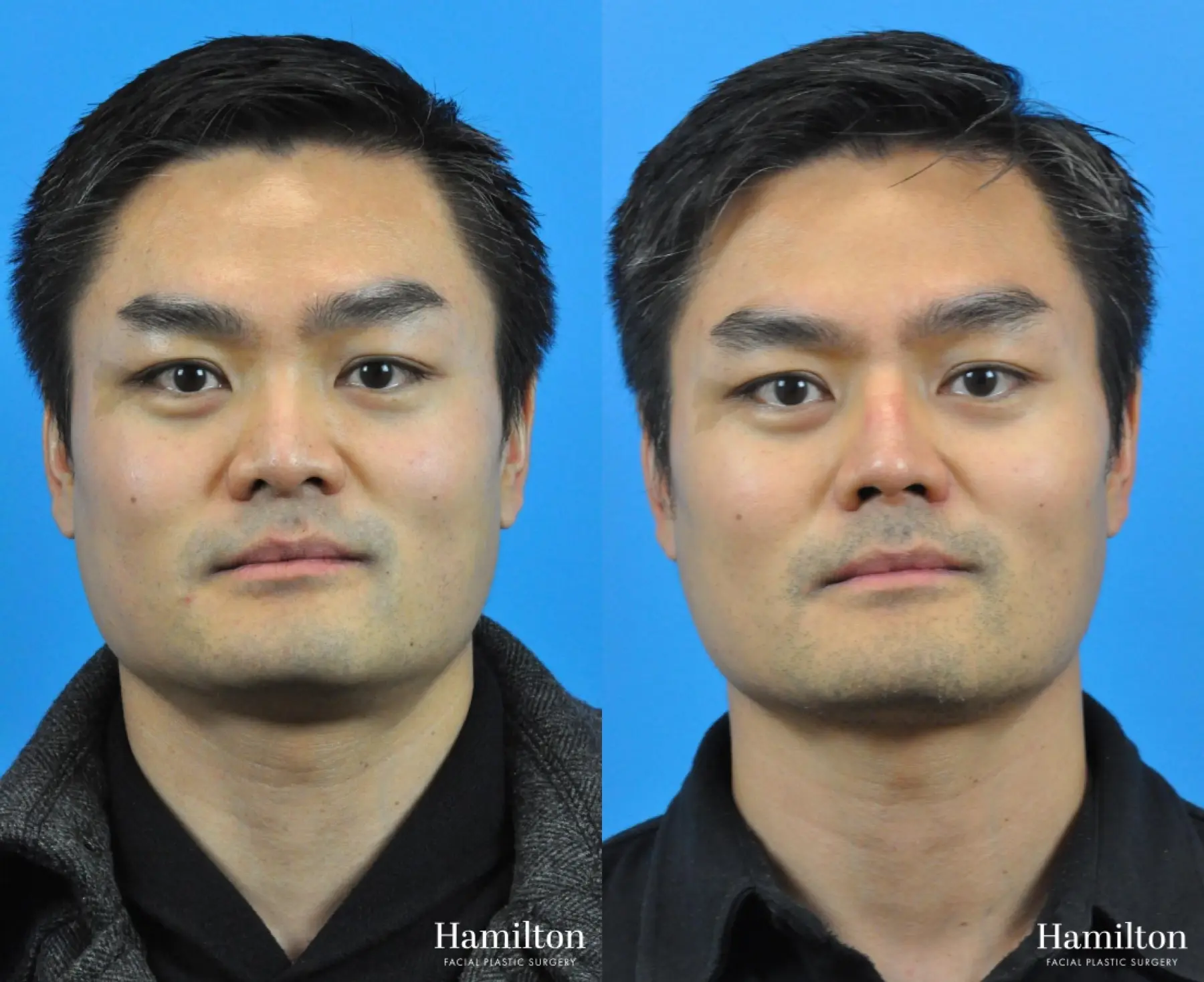 Rhinoplasty: Patient 23 - Before and After 5