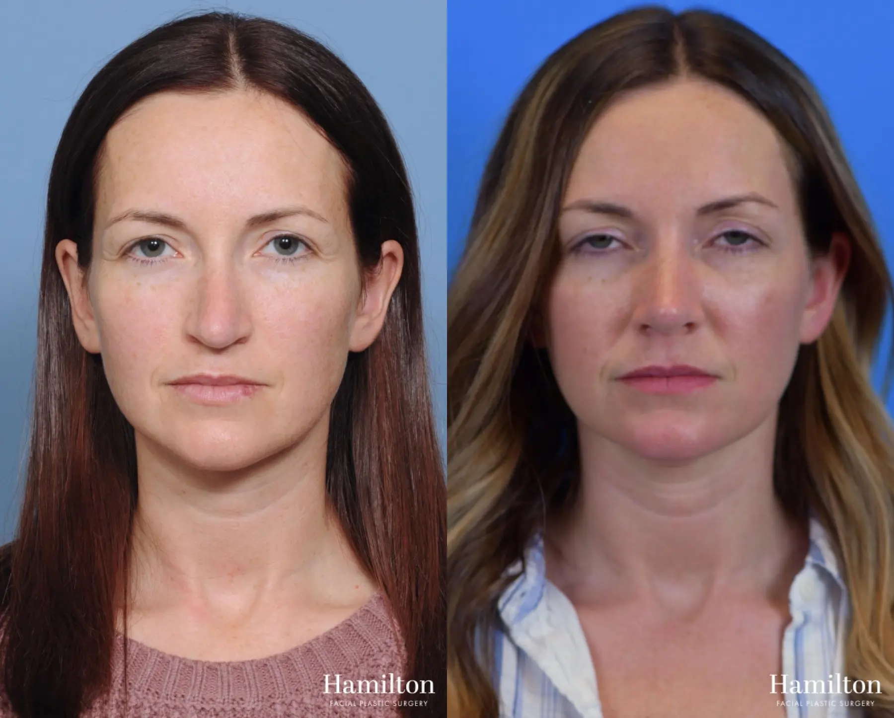 Rhinoplasty: Patient 7 - Before and After 3