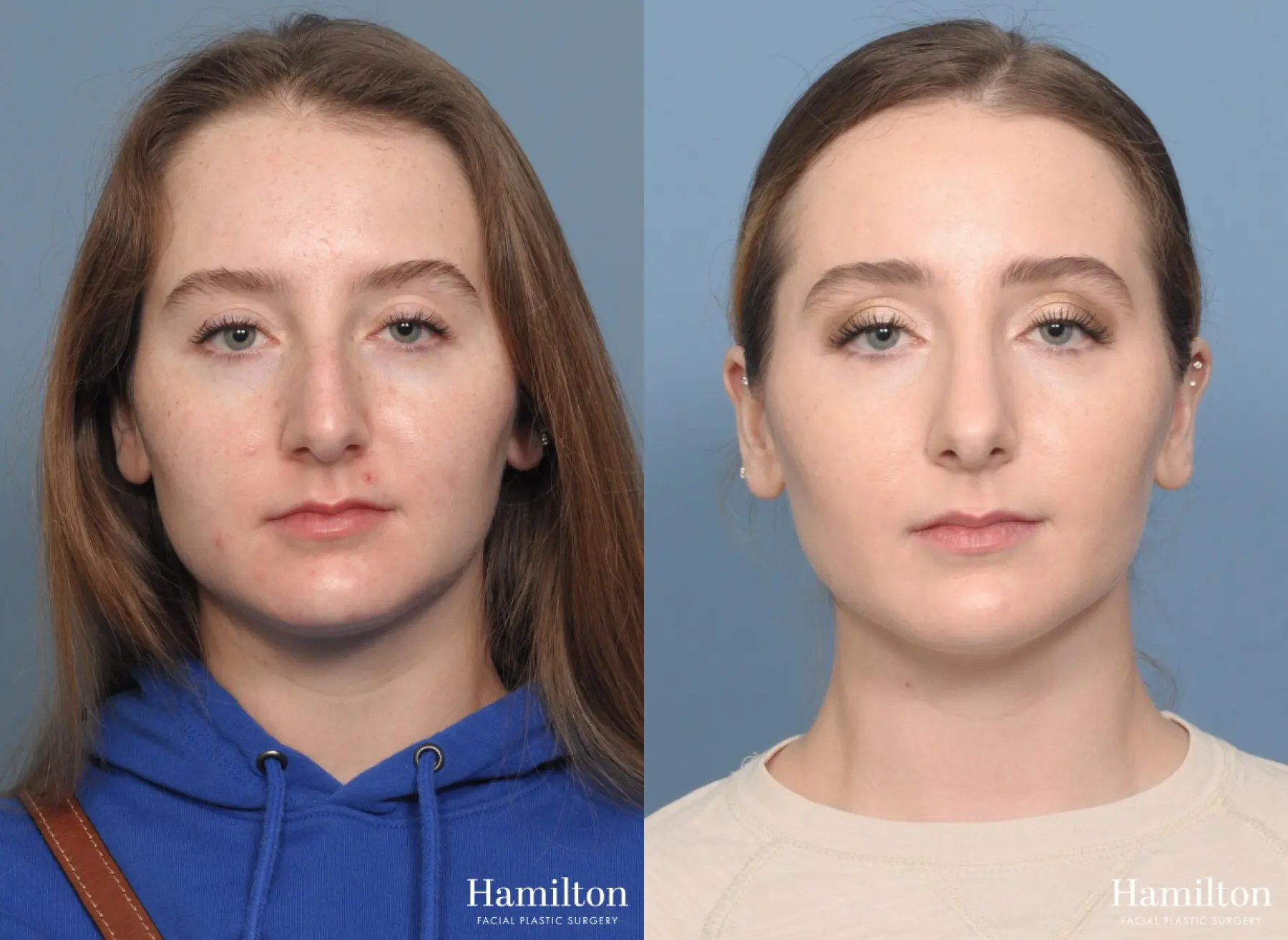 Rhinoplasty: Patient 1 - Before and After 5